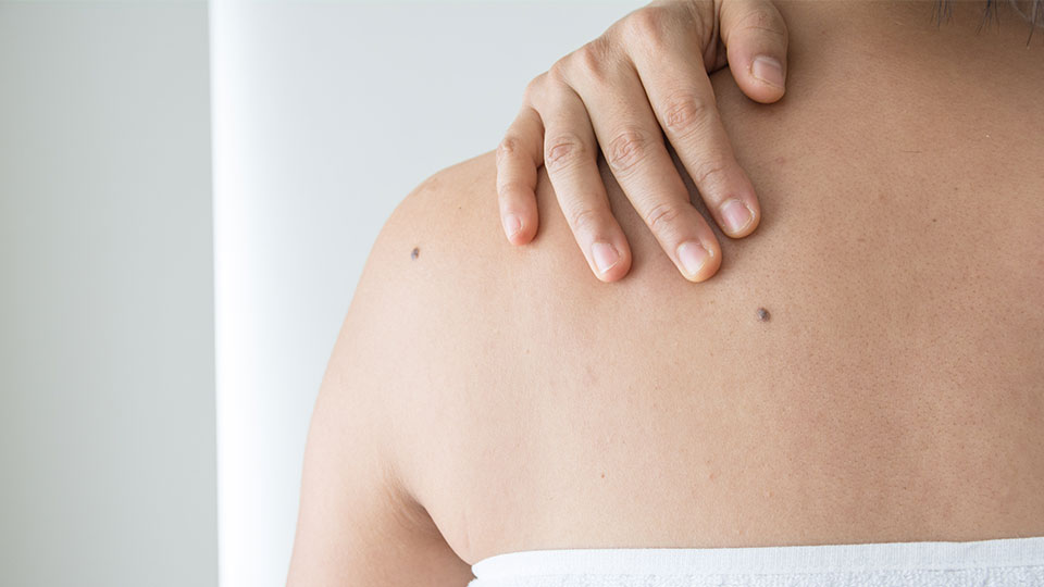 best skin tag remover tool