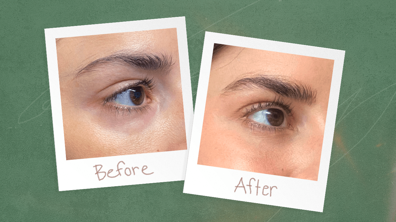 woman before and after pinch prodecure